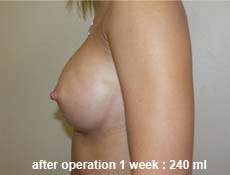 plastic-surgery-breast-augmentation 